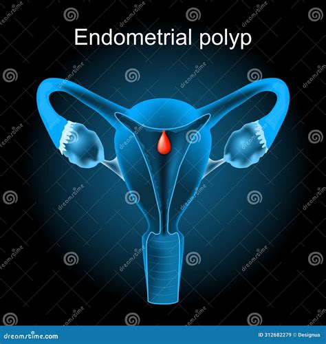 Endometrial Polyp Cross Section Of A Human Uterus With Uterine Polyp