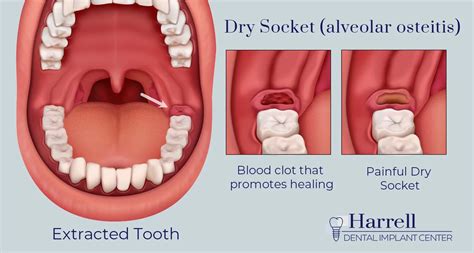 Dry Socket Symptoms Treatment Harrell Dental Implant Center