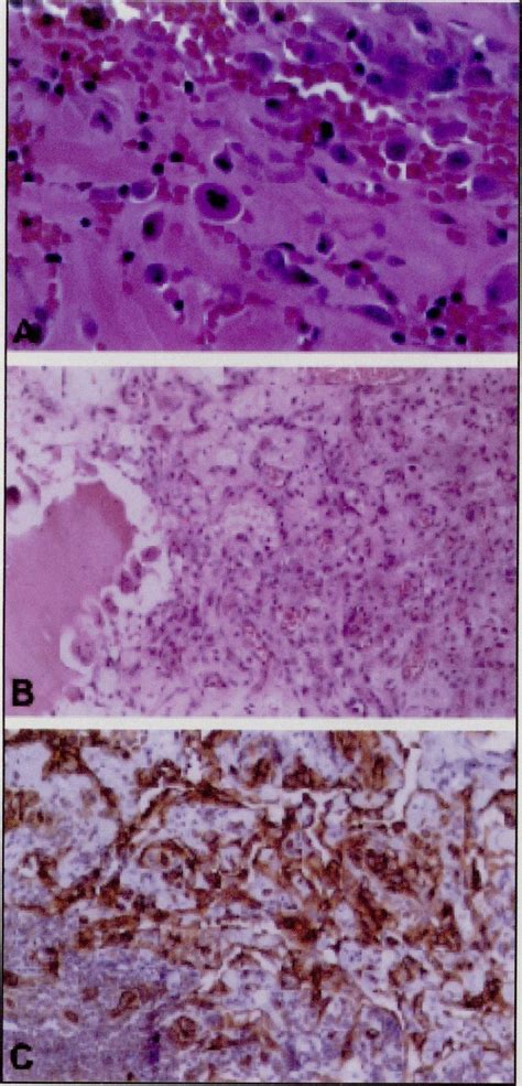 A Atypical Endothelial Cells With Hyperchromatic Nuclei And An