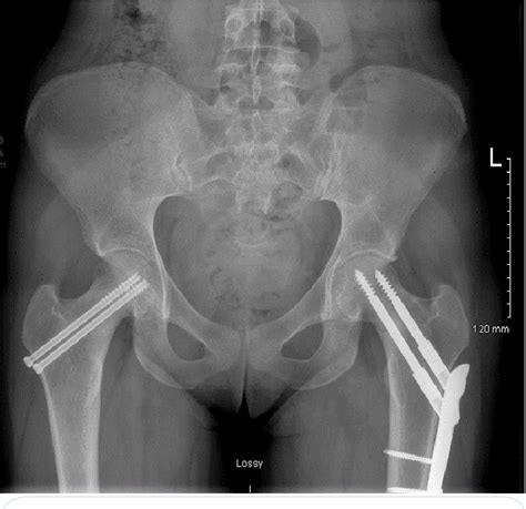 Figure 2 From Bilateral Femoral Neck Stress Fractures In A Female