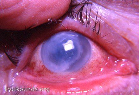 Hypopyon. EyeRounds.org: Online Ophthalmic Atlas