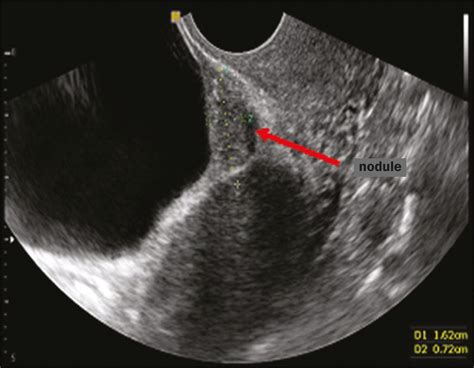 Endometriosis Transvaginal Ultrasound