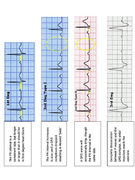 Types of Heartblocks | PDF