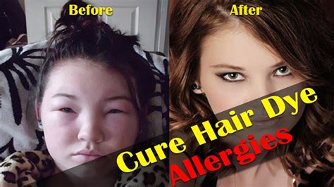 Home Remedies For Hair Dye Allergies Healthcare Youtube