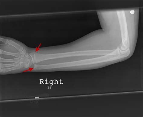 Galeazzi fracture healing time - outlery