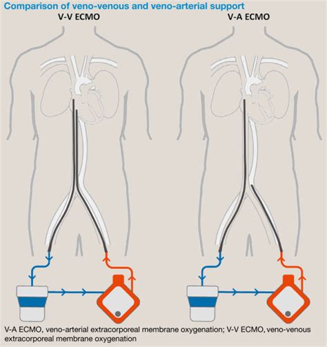 Extracorporeal Support Of The Respiratory System Anaesthesia