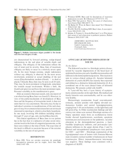 Pdf Annular Lichenoid Dermatitis Of Youth Murat Durdu