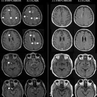 Case 2 An Initial Axial T1 Postcontrast And T2 FLAIR MRI Brain Scan