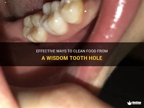 Effective Ways To Clean Food From A Wisdom Tooth Hole MedShun