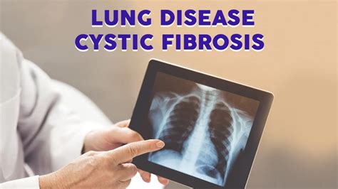 Lung Disease Cystic Fibrosis Dr Rajat Trehan