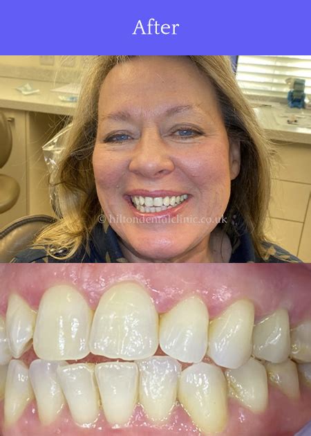 Invisalign In West Bridgford See Us At Hilton Dental Clinic For