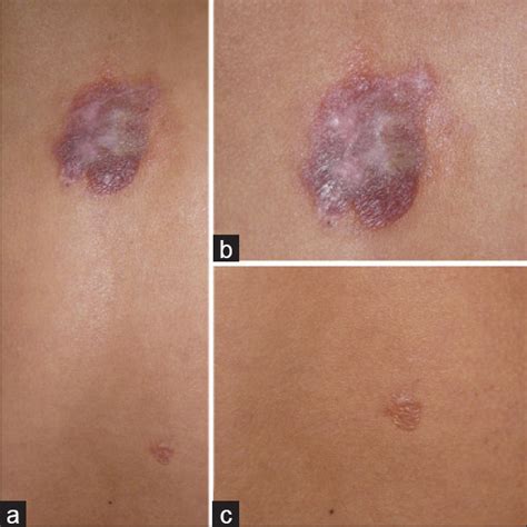 Primary Localized Cutaneous Nodular Amyloidosis With Bullous Lesions Indian Journal Of