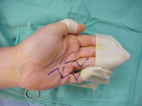 Dupuytren S Palmar Fasciectomy With Extended Bruner Incisions