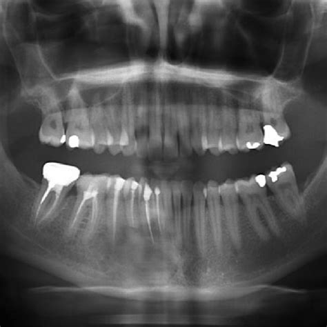 Orthopantomograph Showing A Unilocular Radiolucent Lesion In The Ramus