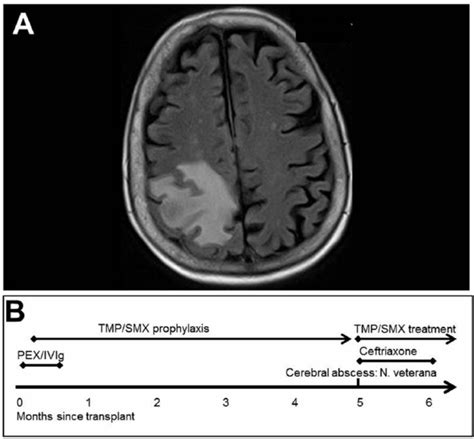 A Cerebral Magnetic Resonance Imaging MRI Shows A Right