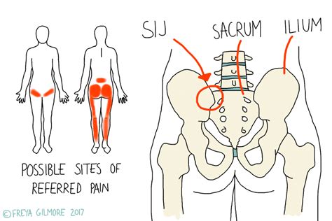 SIJ Pain and Pregnancy - Osteopathy & Medical Acupuncture.