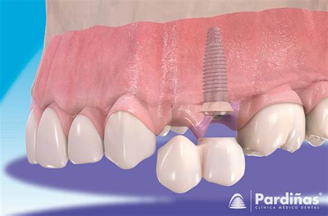 The Dental Bridge Types Parts And Placement Of The Bridge Cl Nica