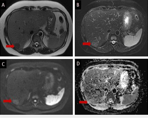 Figure 3 From Multifocal Nodular Fatty Sparing Mimicking Hepatic Tumors