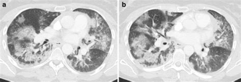 Pneumocystis Jirovecii Infection Ct Showed A Patchy Di Open I