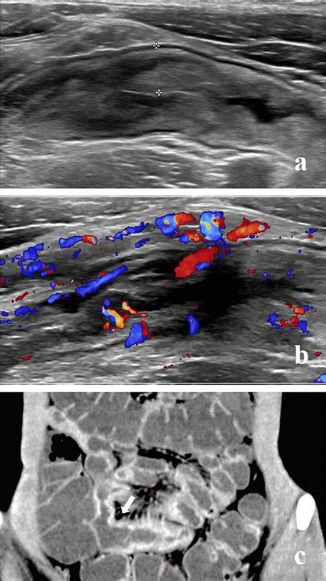 Ius And Cte Findings In A Representative Patient With Crohns Disease