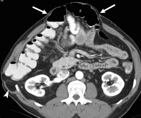 Abdominal Wall Hernias Imaging Features Complications And Diagnostic