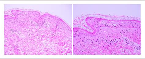 Figure 3 From A Case Of Toxic Epidermal Necrosislike Cutaneous