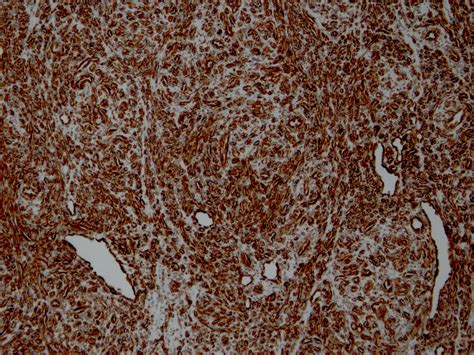 Pathology Outlines Kaposiform Hemangioendothelioma