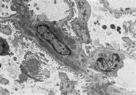 Ajkd Atlas Of Renal Pathology C1q Nephropathy American Journal Of