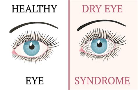 What Is Chronic Dry Eye | Toronto, ON | See & Be Seen Eyecare