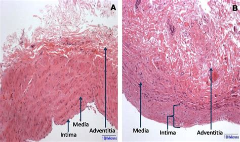 Preoperative Venous Intimal Hyperplasia Postoperative Arter