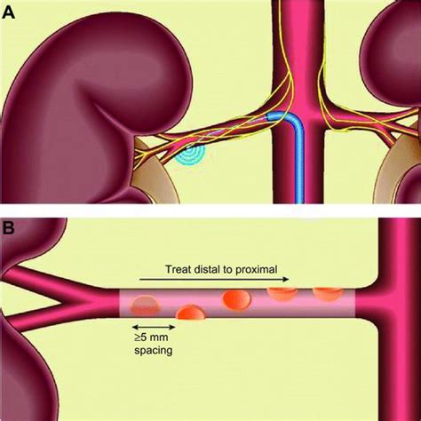 Procedimento De Denervação Simpática Renal Em A Aortografia Abdominal Download Scientific