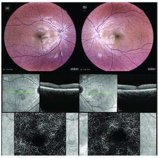 Structural Optical Coherence Tomography OCT And OCT Angiography