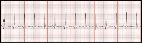 Float Nurse Practice Ecg Rhythm Strip 108