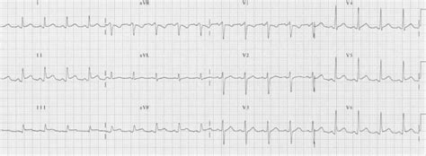 The St Segment • Litfl • Ecg Library Basics