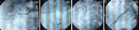 A Fluoroscopic Spot Image From A Right Renal Arteriogram Shows No