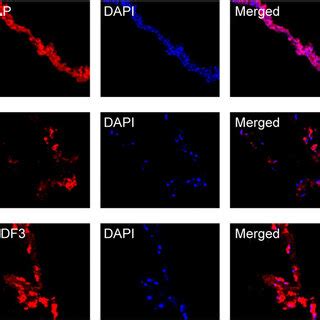 The Expression Of WTAP FTO And YTHDF3 In Surgically Excised Human PDR