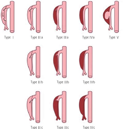 Figure 3 From The Classification And Management Strategy Of Spontaneous