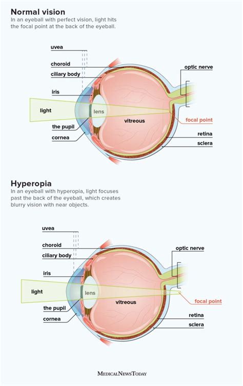 Farsightedness: Symptoms, Causes Treatment, 42% OFF