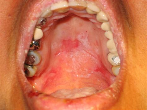 Pemphigus Vulgaris Oral Lesions