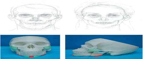 Simultaneous Zygomatic Osteotomies With Reduction Mandibulop