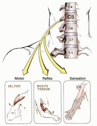 C5 Nerve Root Impingement