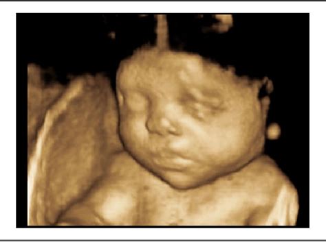 Figure 1 From Prenatal Sonographic Detection Of Skeletal Dysplasias