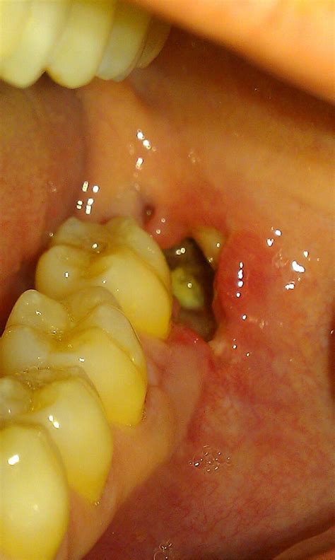 Figure Alveolar Osteitis With Alveolar Bone Statpearls Ncbi