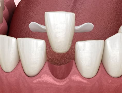 Maryland Bridge Made From Ceramic Front Tooth Recovery Medically