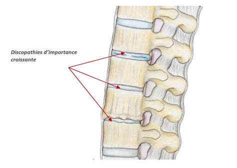 Discopathie Dégénérative Lombaire Chirurgie De La Colonne Vertébrale