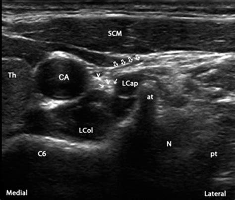 Ultrasound Guided Percutaneous Cervical And Upper Thoracic Sympathetic