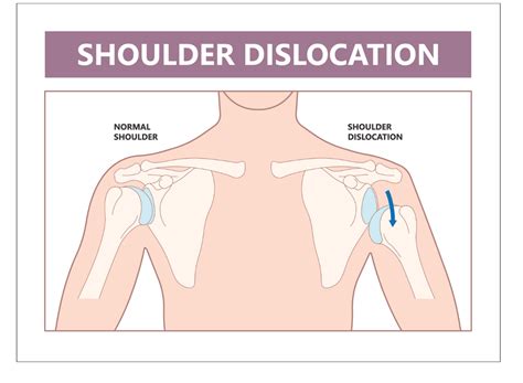 Separated Shoulder Vs Dislocated Shoulder AOS