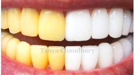 Teeth Whitening At Home In 3 Minutes How To Whiten Your Yellow Teeth Naturally 100