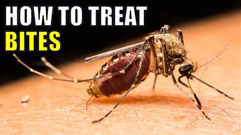 Mosquito Bites 14 Effective Home Remedies For Treating Mosquito Bites