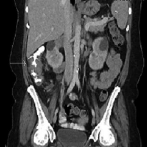 CT scan of abdomen with contrast with apple-core lesion in ascending ...